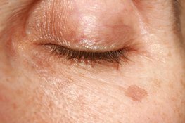 How to remove age spots?